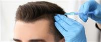 نصائح لما بعد زراعة الشعر