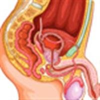Genes May Influence Impotence After Prostate Radia