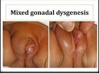 Orchiopexy for Undescended Testicle