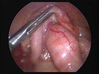 Laparoscopic Approach to Appendectomy