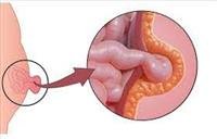 Umbilical hernia..