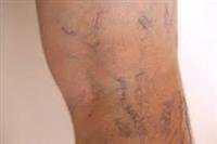 Varicose Vein Treatments All Work