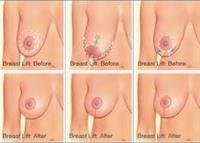 Breast Lift Surgery