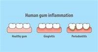 PREVENTING PERIODONTAL DISEASE