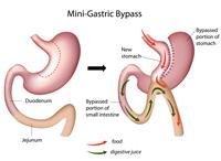 Abdominal "packing": indications and method