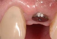 Study: Root Canals and Dental Implants