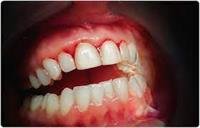 Bleeding Gums.