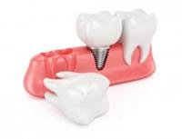 depression drug and dental implant failure