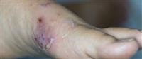 Cellulitis: Your comprehensive guide.