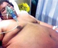 Transverse Myelitis: What It Is and How It's Conne
