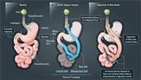 How Bariatric Surgery Works