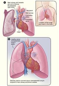 What To Expect During a Lung Transplant