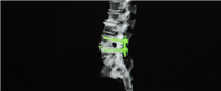 Vertebral stabilization process,,,,,,