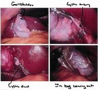 Laparoscopic surgery