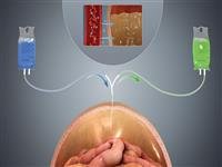 Dialysis