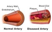 Early Heart Disease May Lead to Impotence, Study