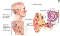 Cochlear implants procedure