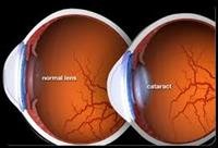 A Visual Guide to Cataracts