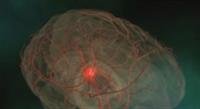 Memory Lapses May Signal Stroke Risk: Study