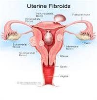Uterine Fibroids