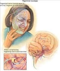 Trigeminal neuralgia
