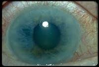 Glaucoma