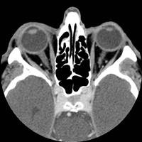 Optic Neuritis