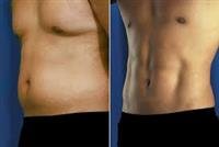 Liposuction