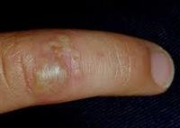 Blisters