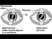 Retinoscopy Procedure