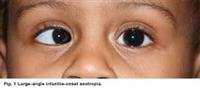 Strabismus - Topic Overview