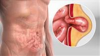 Hernia Repair What Is It?
