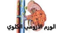 Nephroblastoma