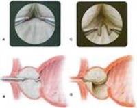 What You Need to Know About Prostate Surgery