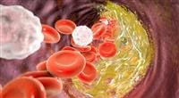 What Is Atherosclerosis?.