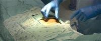 Laparoscopic gallbladder surgery,,,