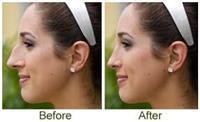 Nose surgery ... motives not related to beauty