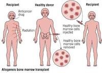 Bone Marrow Transplants
