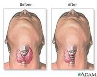Thyroid Surgery