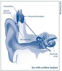 What is a cochlear implant?