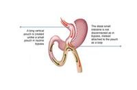 Mini Gastric Bypass