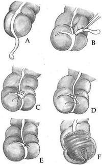 What is Laparoscopic Appendix Removal Surgery