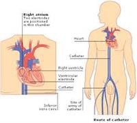 Heart Disease and Electrophysiology