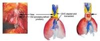 Traditional Treatment Methods for Enlarged Prostat
