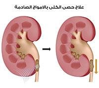 Breaking up kidney stones