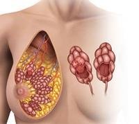 mastectomy,