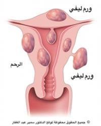 Uterine tumors