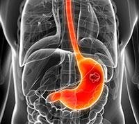 Stomach cancer Symptoms & causes