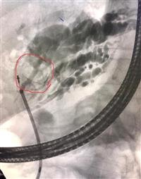 Lithotripsy of the bile duct, by stenotoscopic