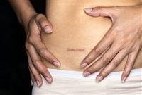 What Is an Appendectomy?